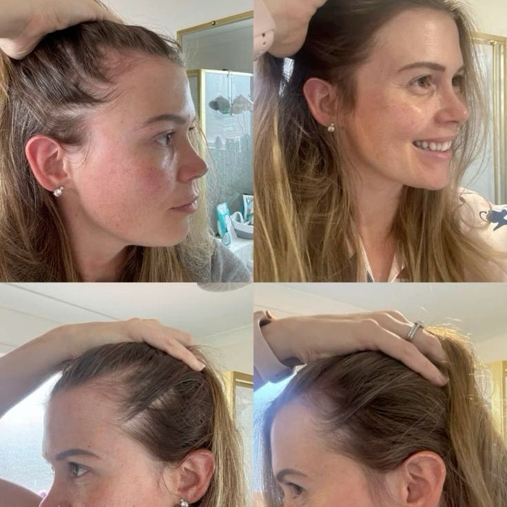 "Ya no sabía como disimular mis entradas, hasta ahora..."